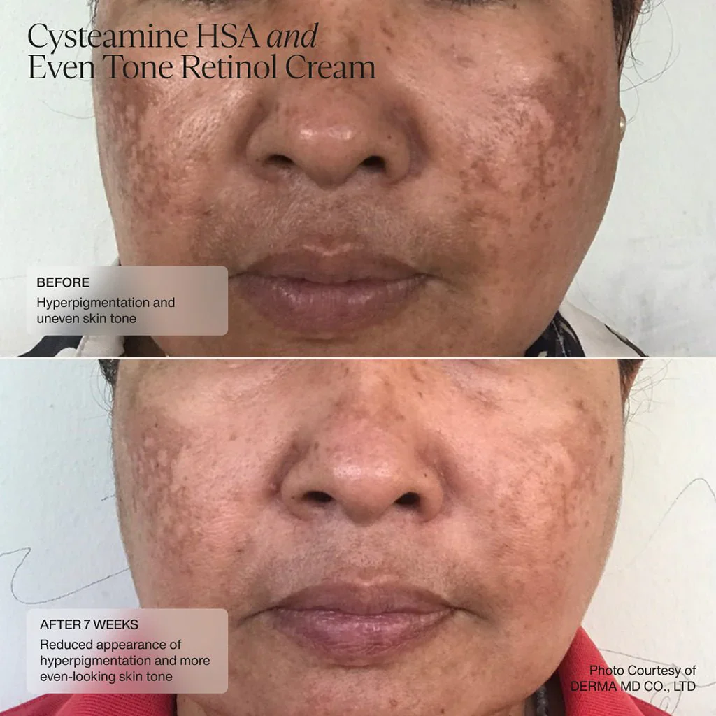 Senté | Cysteamine + HSA Pigment & Tone Corrector (50ml) - Image 10
