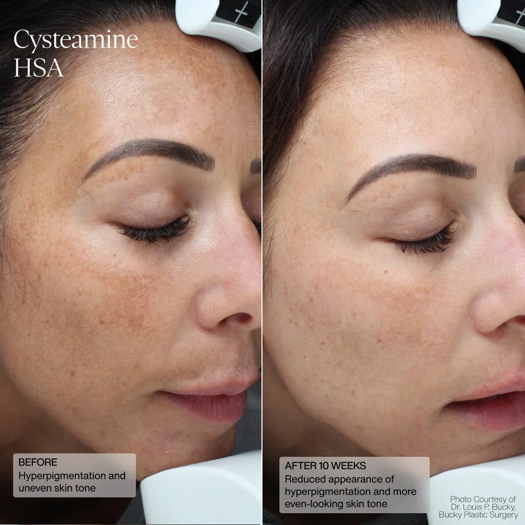 Senté | Cysteamine + HSA Pigment & Tone Corrector (50ml) - Image 11
