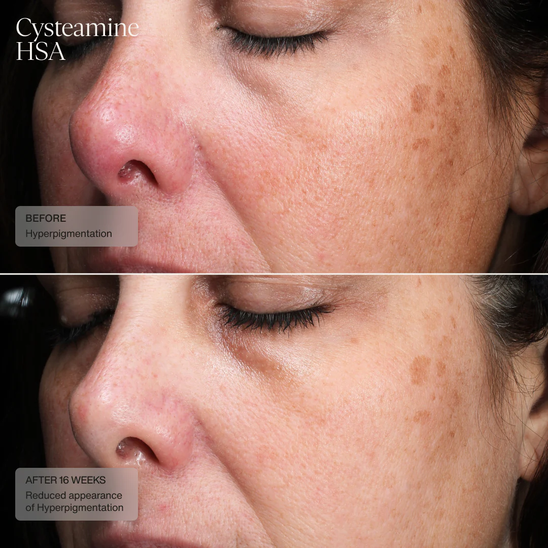 Senté | Cysteamine + HSA Pigment & Tone Corrector (50ml) - Image 4