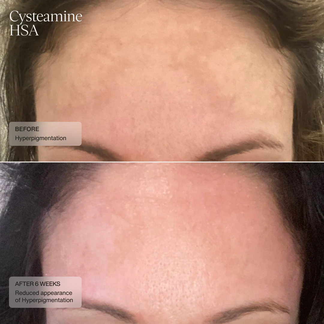 Senté | Cysteamine + HSA Pigment & Tone Corrector (50ml) - Image 5