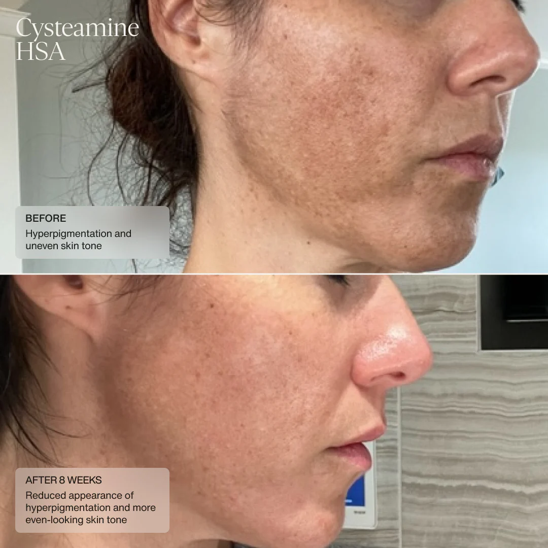 Senté | Cysteamine + HSA Pigment & Tone Corrector (50ml) - Image 6