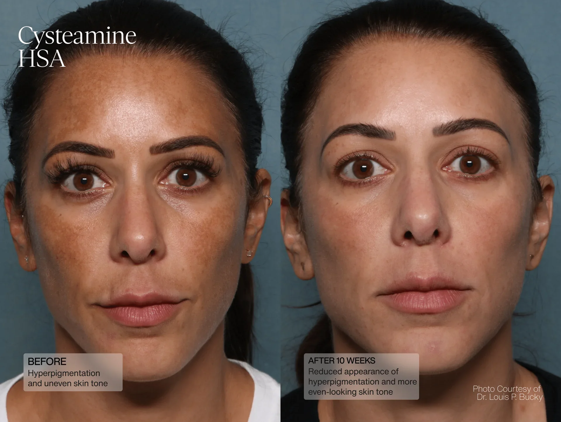 Senté | Cysteamine + HSA Pigment & Tone Corrector (50ml) - Image 8