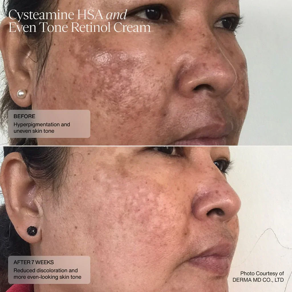Senté | Cysteamine + HSA Pigment & Tone Corrector (50ml) - Image 9